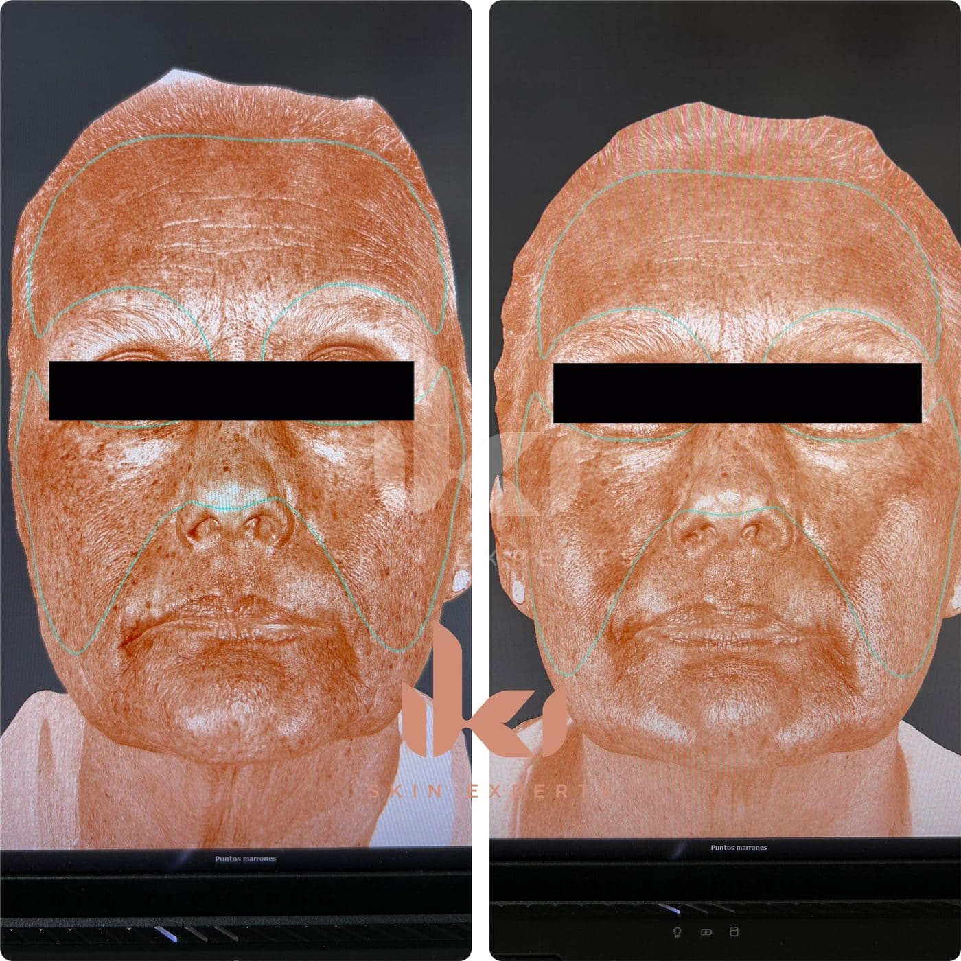 Antes y después de manchas y melasma en IKI Skin Experts, caso 1, identidad protegida