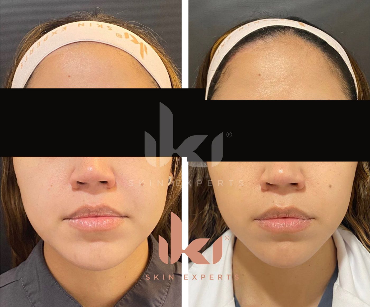 Antes y después de otros casos en IKI Skin Experts, caso 4, identidad protegida