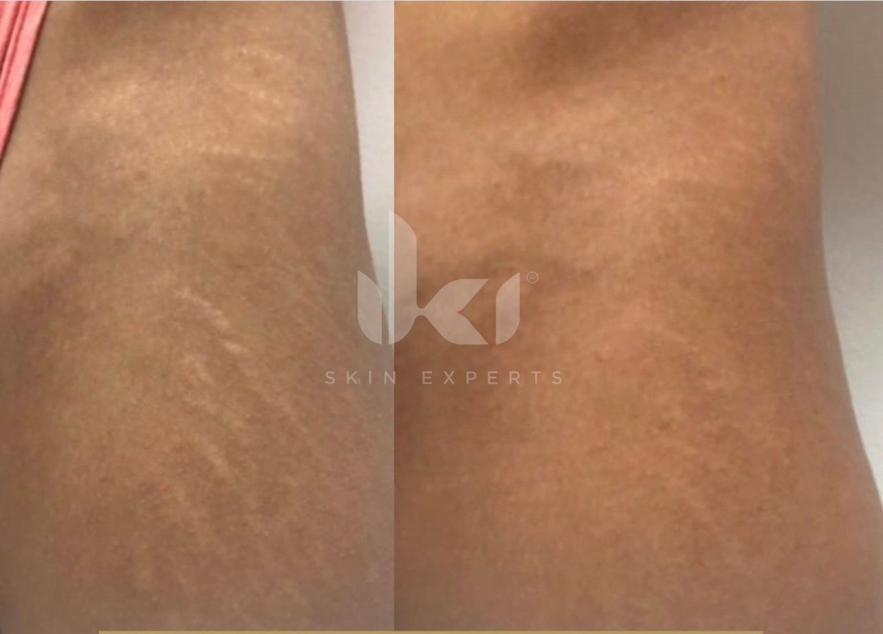 Antes y después de estrías en IKI Skin Experts, caso 3, identidad protegida