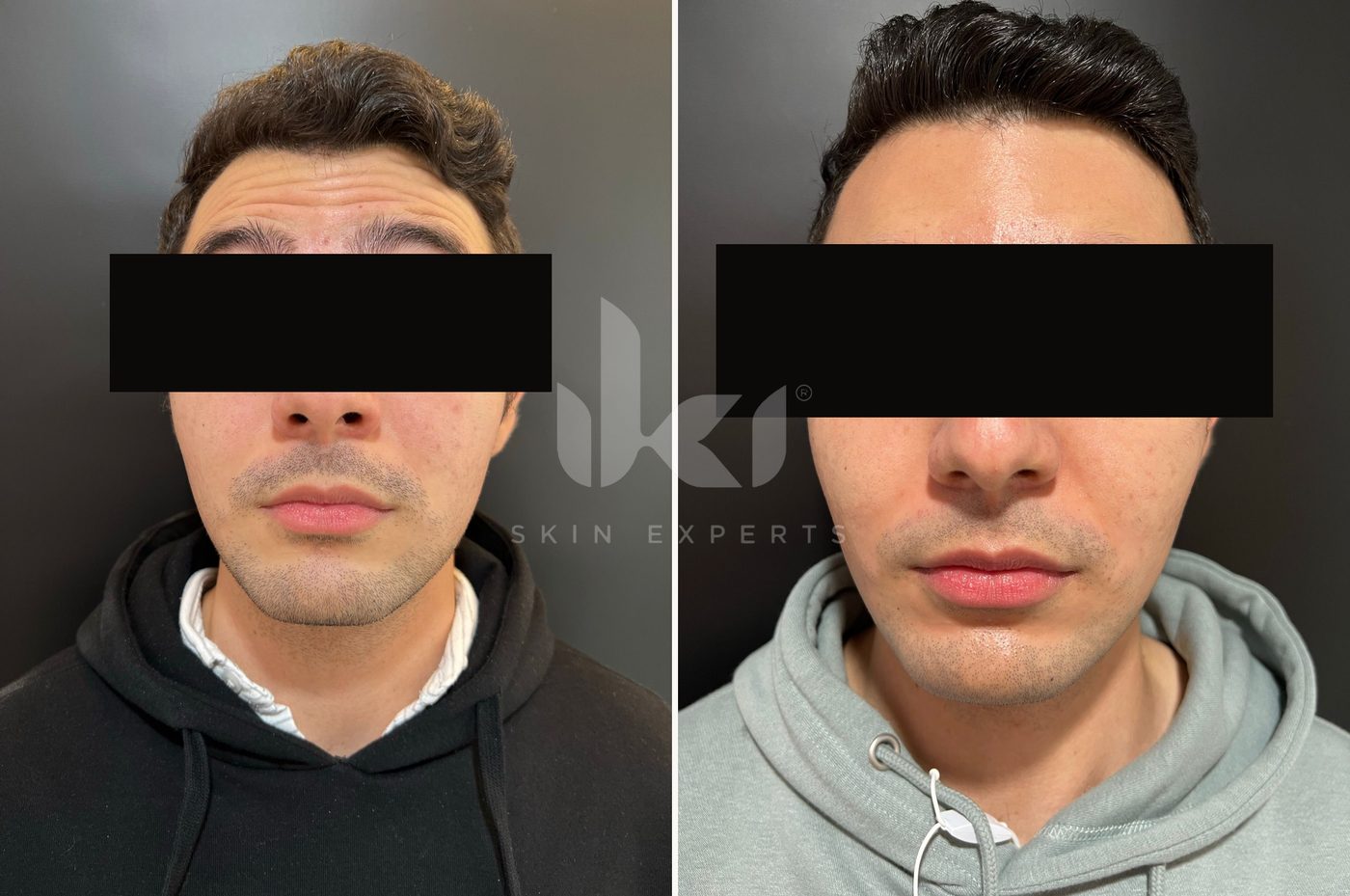 Antes y después de toxina botulínica en IKI Skin Experts, caso 1, identidad protegida
