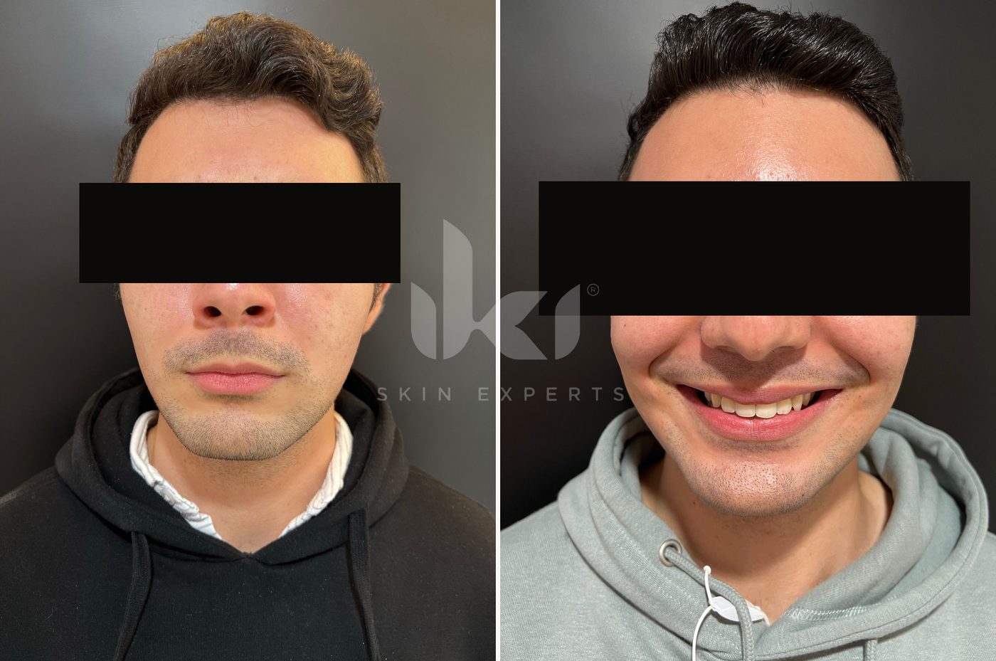 Antes y después de toxina botulínica en IKI Skin Experts, caso 2, identidad protegida