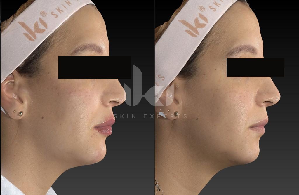 Antes y después de otros casos en IKI Skin Experts, caso 5, identidad protegida