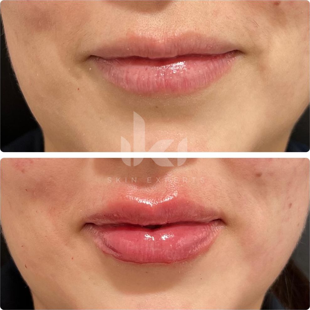 Antes y después de labios en IKI Skin Experts, caso 1, identidad protegida