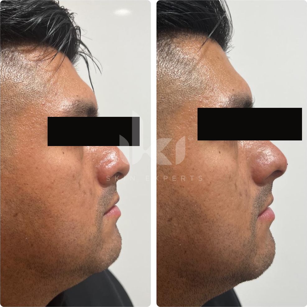 Antes y después de labios en IKI Skin Experts, caso 2, identidad protegida