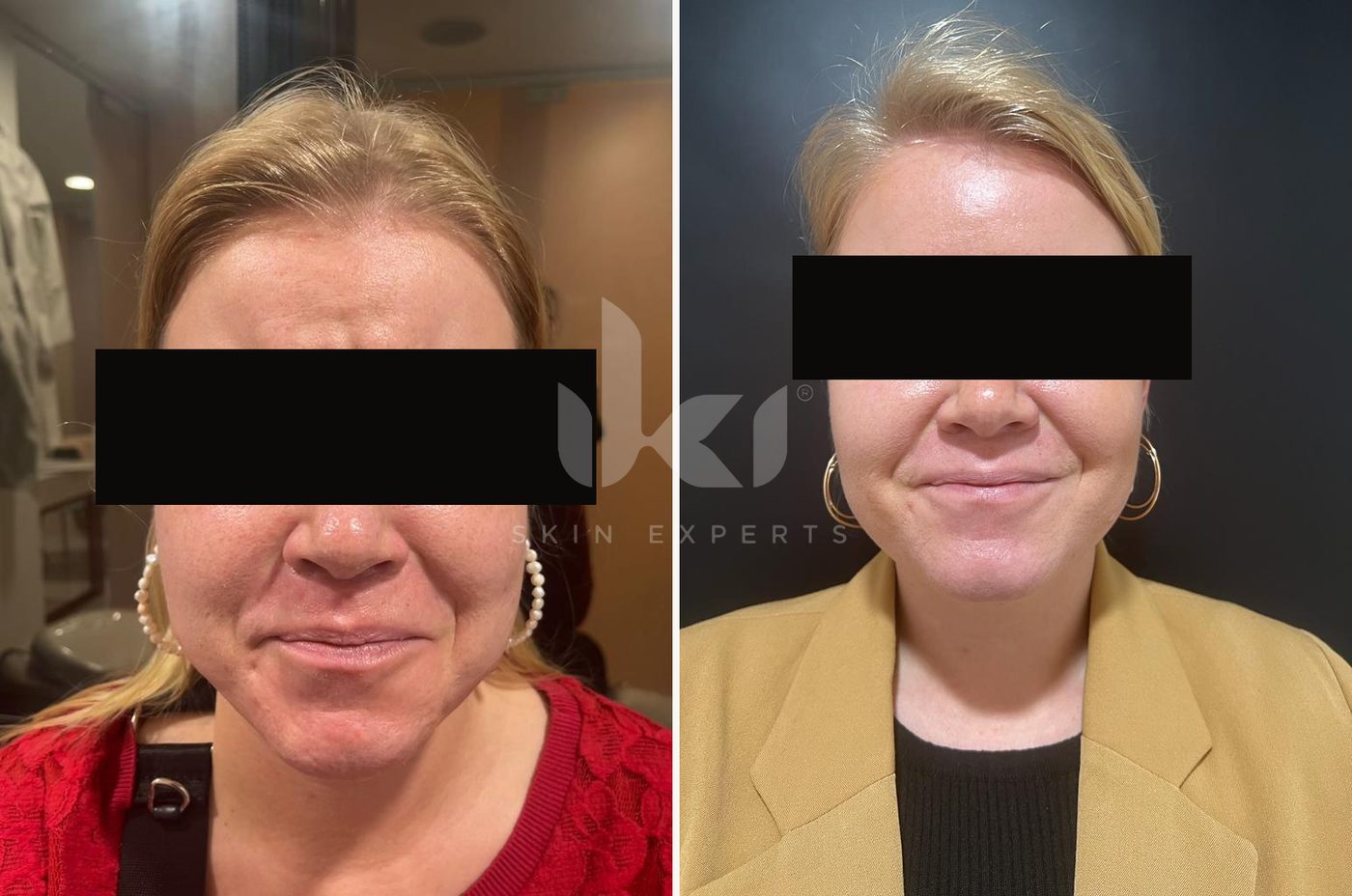 Antes y después de toxina botulínica en IKI Skin Experts, caso 4, identidad protegida