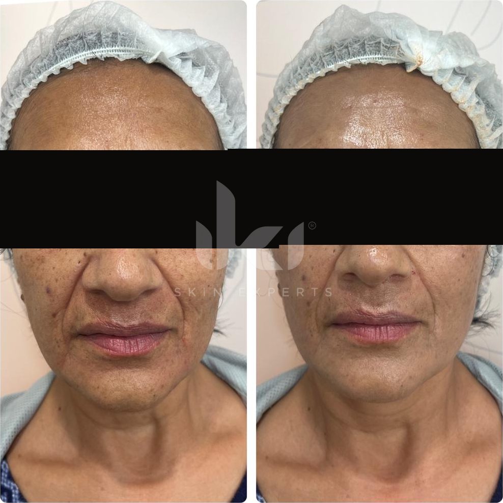 Antes y después de hifu · flacidez en IKI Skin Experts, caso 1, identidad protegida
