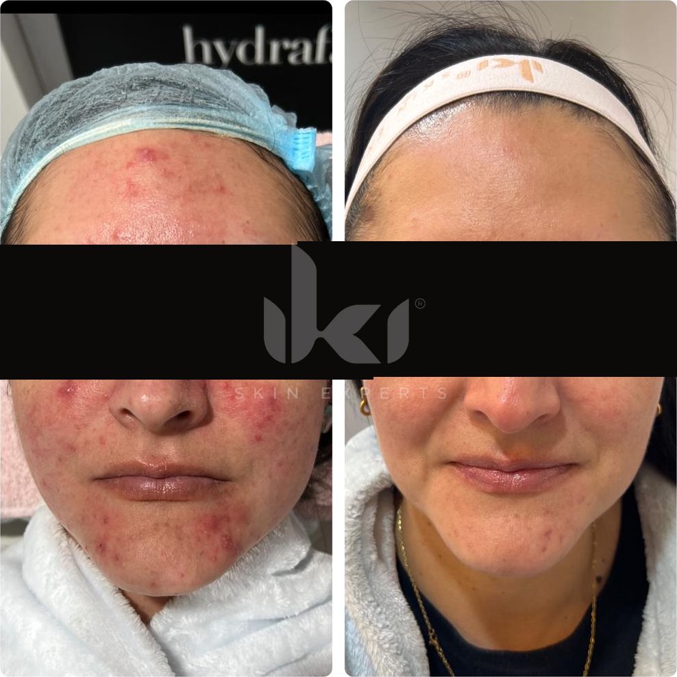 Antes y después de acné en IKI Skin Experts, caso 3, identidad protegida