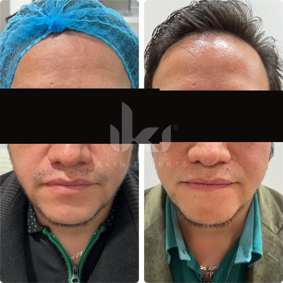Antes y después de labios en IKI Skin Experts, caso 3, identidad protegida