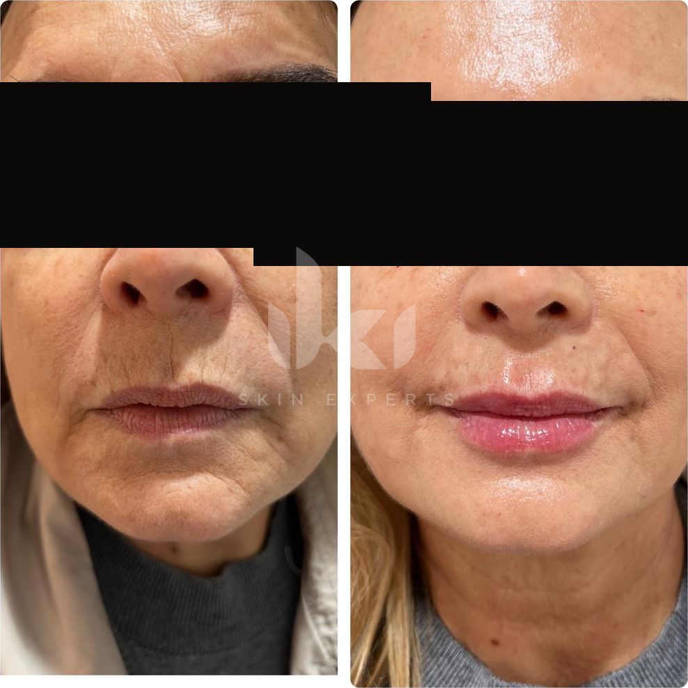 Antes y después de labios en IKI Skin Experts, caso 4, identidad protegida