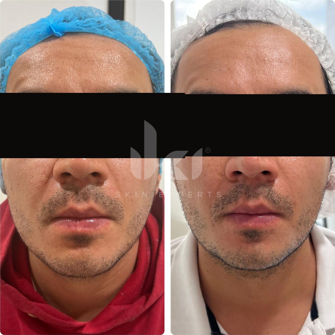 Antes y después de facial médico · hydrafacial en IKI Skin Experts, caso 1, identidad protegida