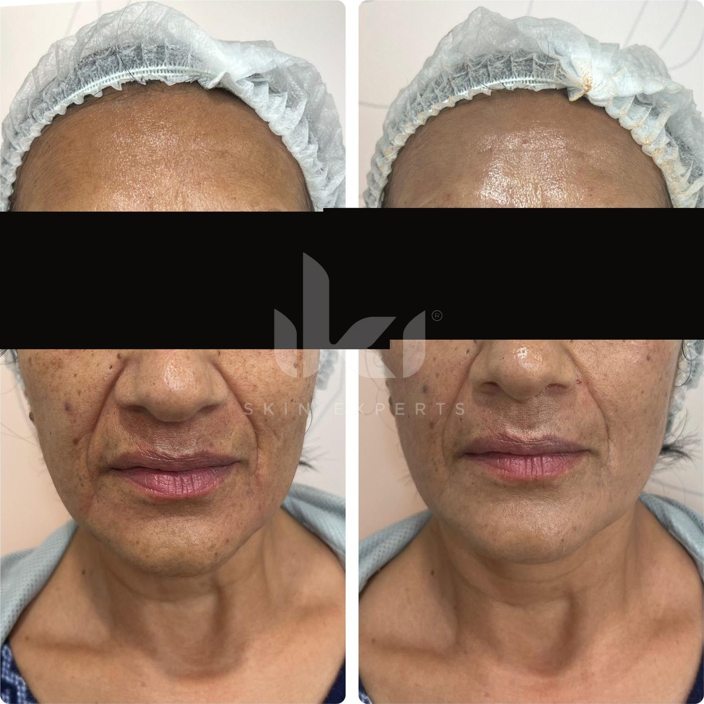 Antes y después de hifu · flacidez en IKI Skin Experts, caso 2, identidad protegida