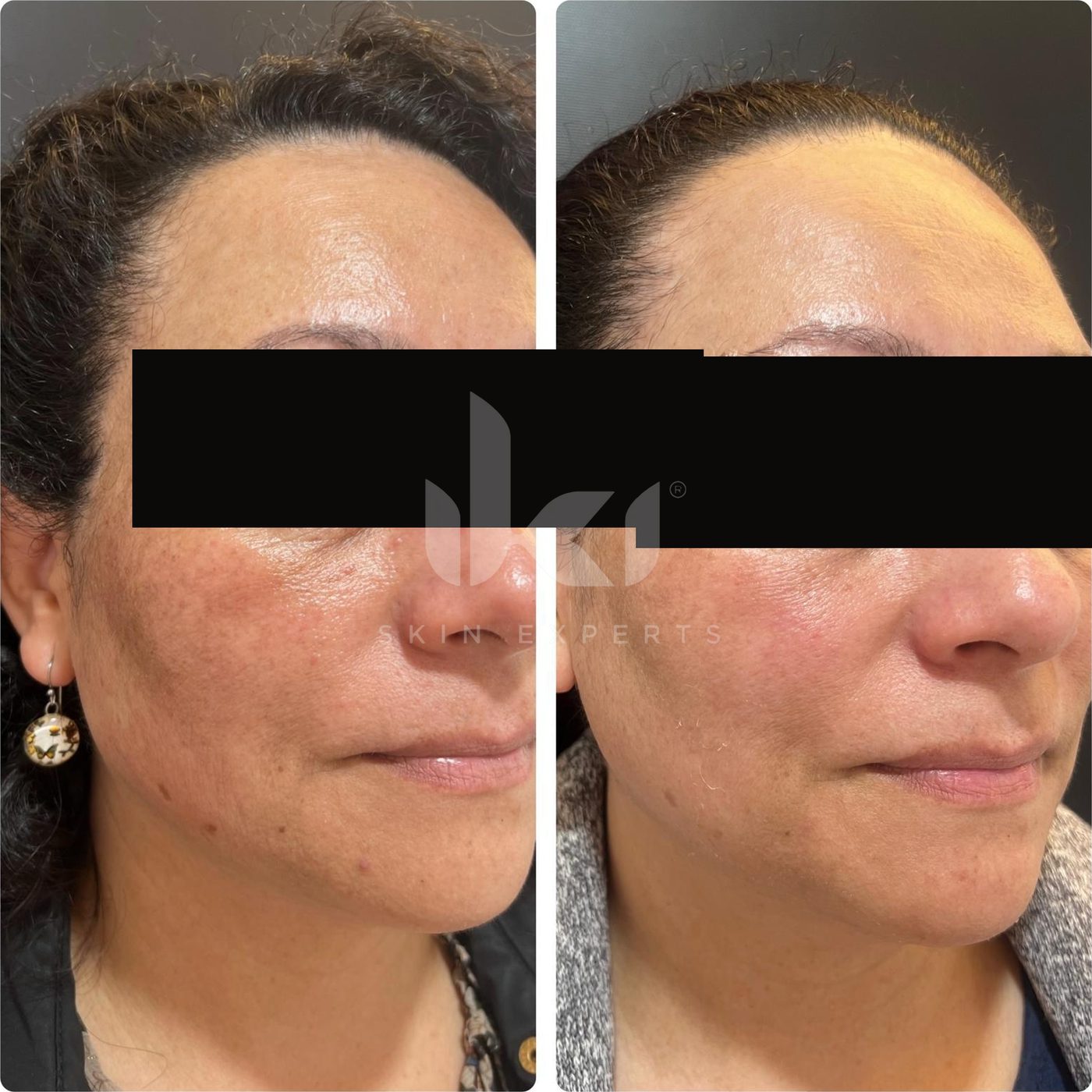 Antes y después de manchas y melasma en IKI Skin Experts, caso 2, identidad protegida