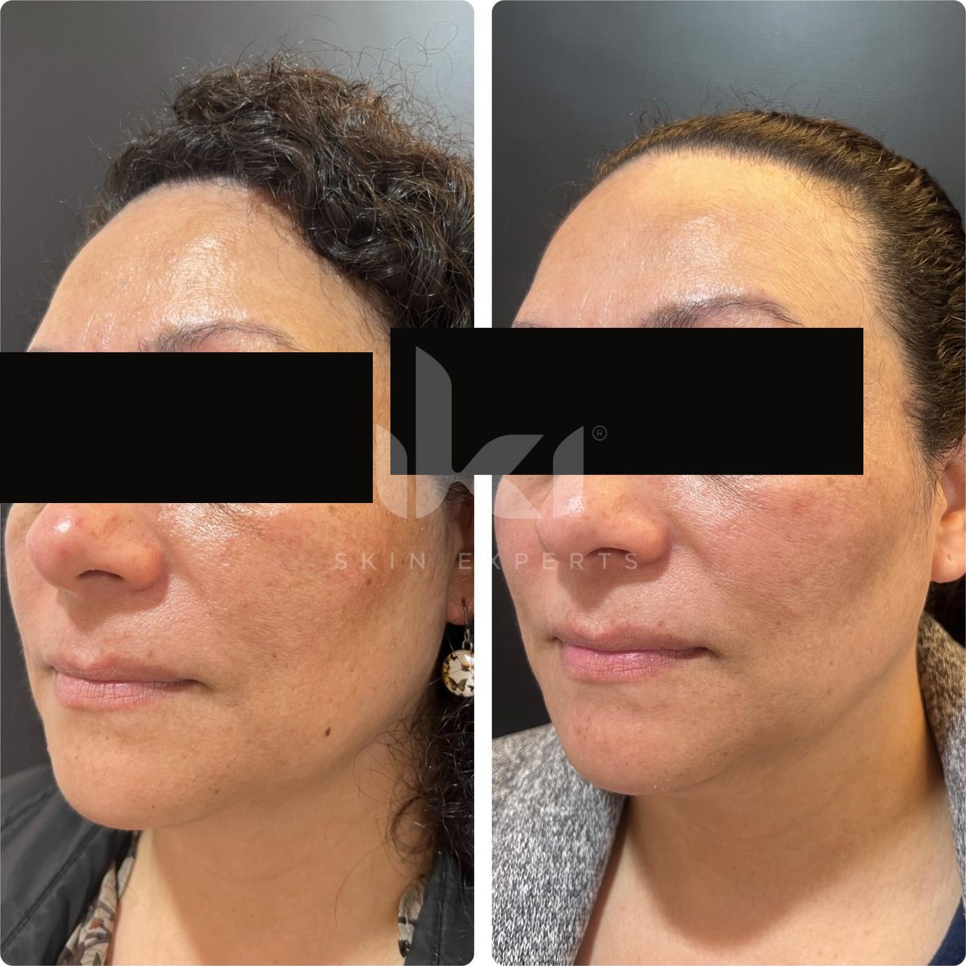 Antes y después de manchas y melasma en IKI Skin Experts, caso 3, identidad protegida