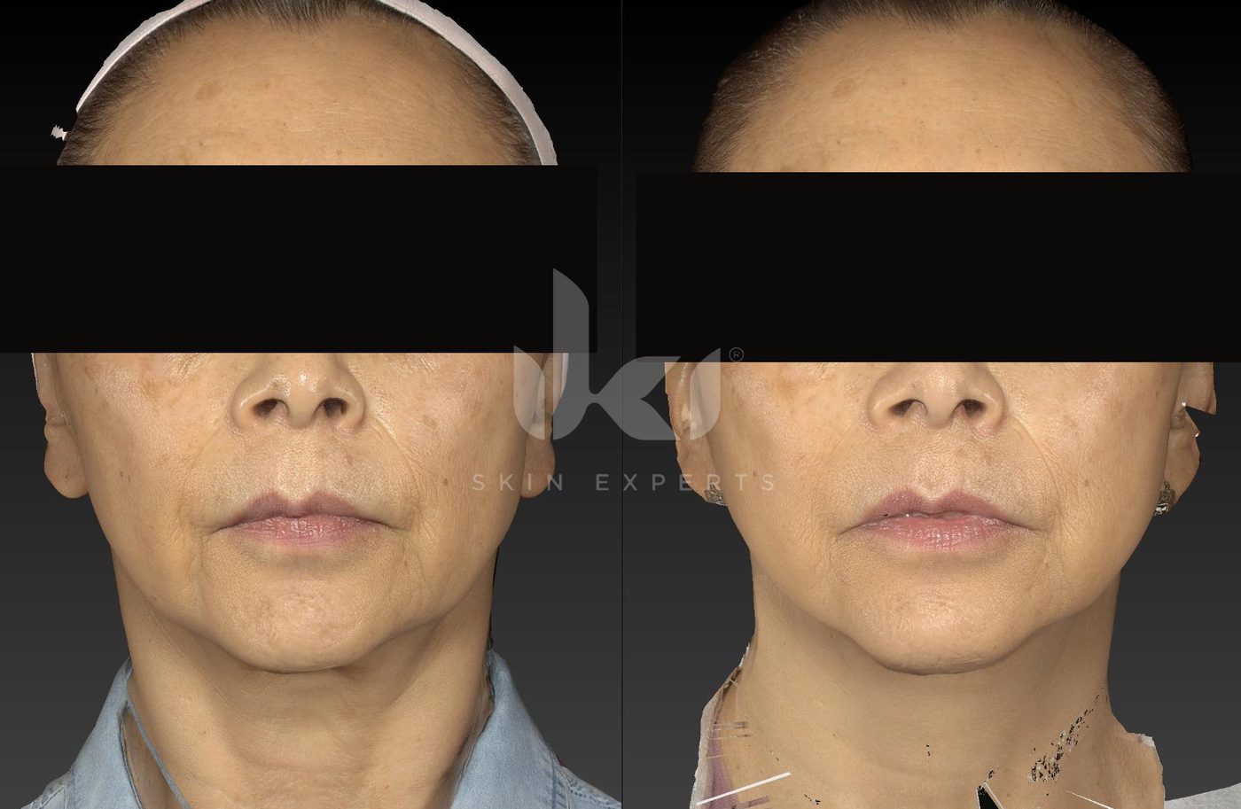 Antes y después de manchas y melasma en IKI Skin Experts, caso 4, identidad protegida