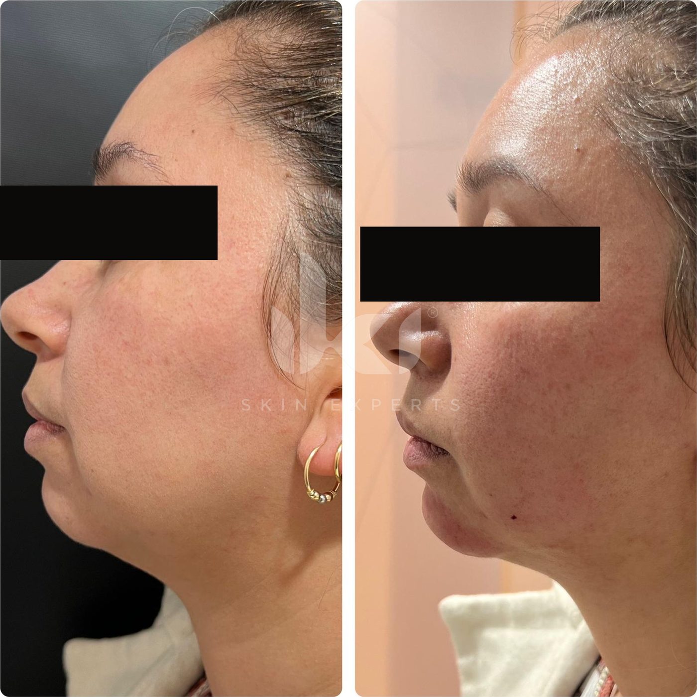 Antes y después de papada en IKI Skin Experts, caso 2, identidad protegida