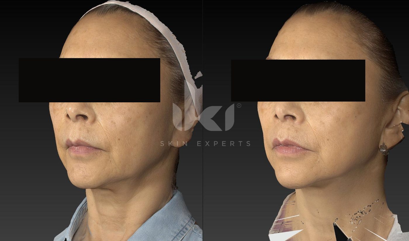 Antes y después de manchas y melasma en IKI Skin Experts, caso 5, identidad protegida