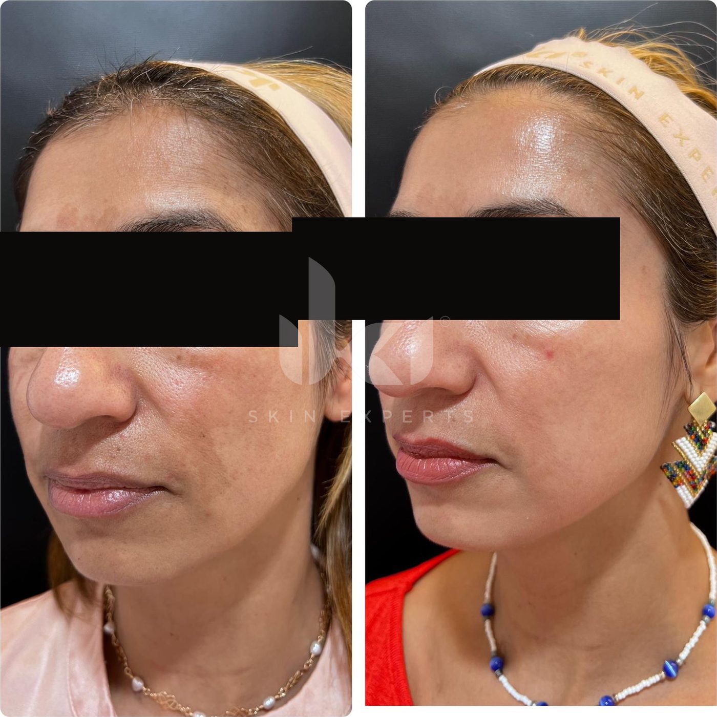 Antes y después de manchas y melasma en IKI Skin Experts, caso 6, identidad protegida