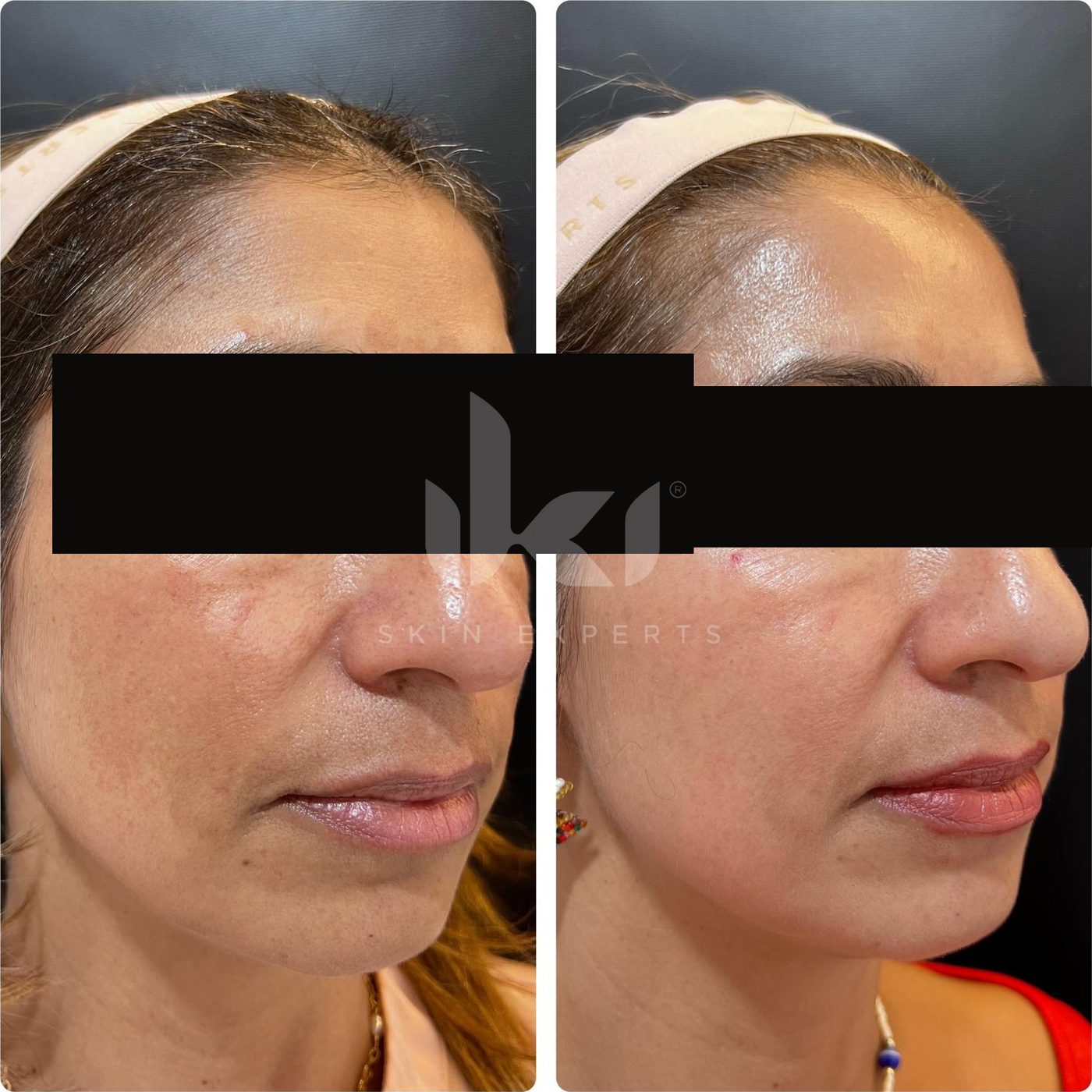 Antes y después de manchas y melasma en IKI Skin Experts, caso 7, identidad protegida