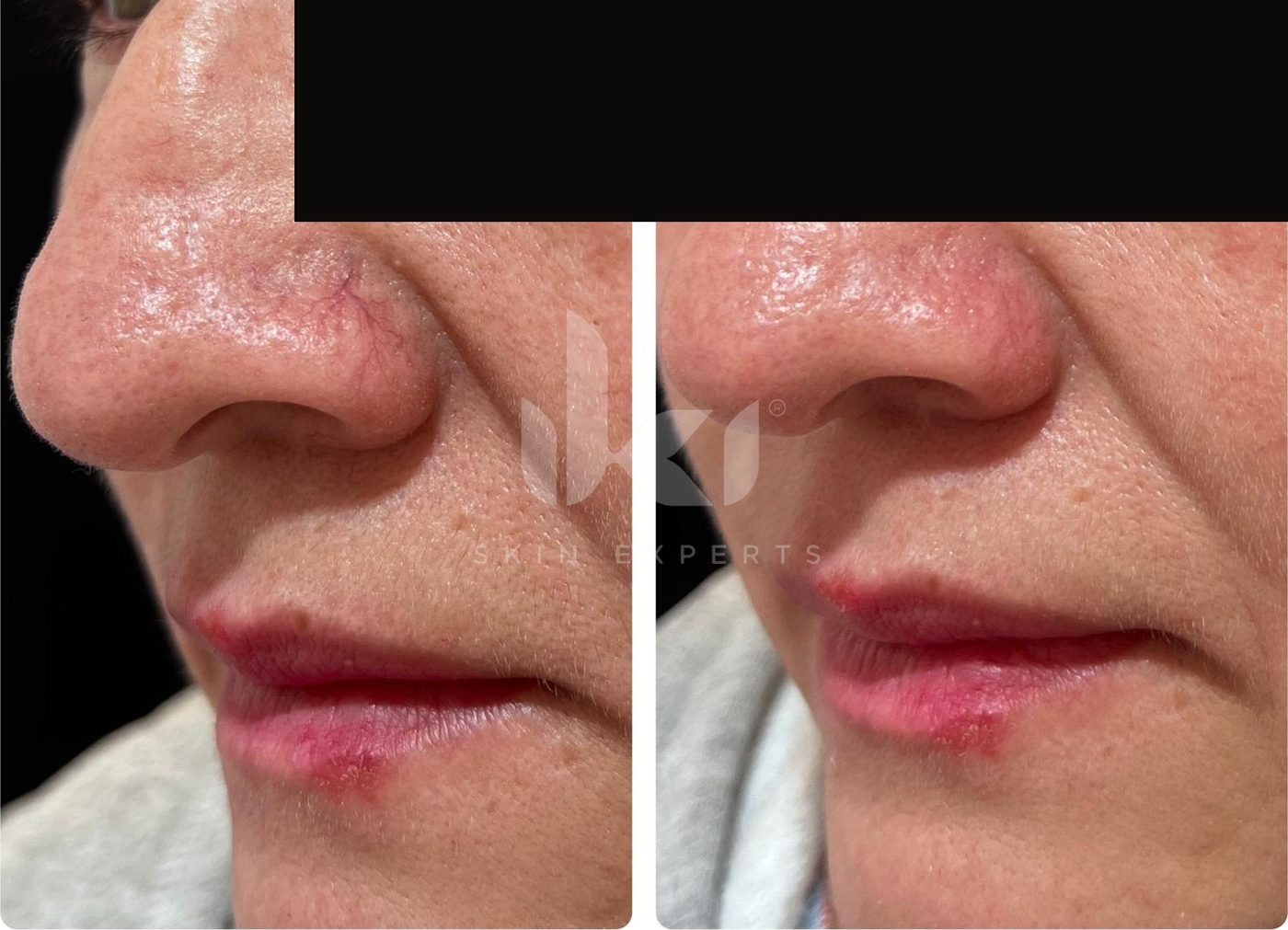 Antes y después de rosácea en IKI Skin Experts, caso 2, identidad protegida