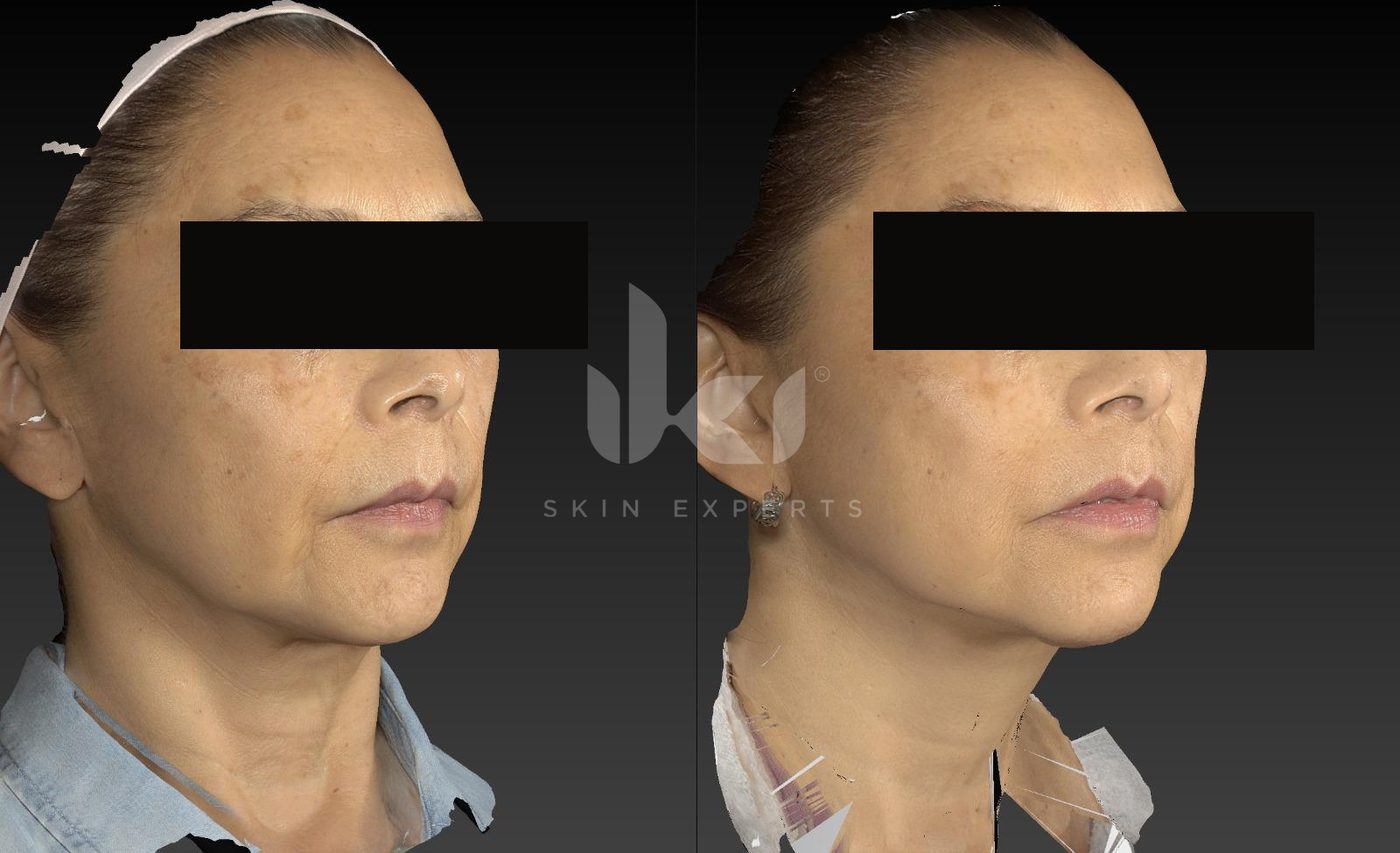 Antes y después de manchas y melasma en IKI Skin Experts, caso 8, identidad protegida