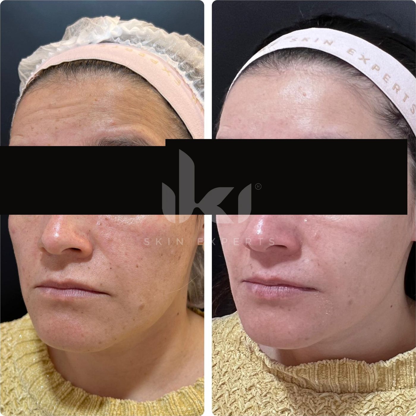 Antes y después de manchas y melasma en IKI Skin Experts, caso 9, identidad protegida