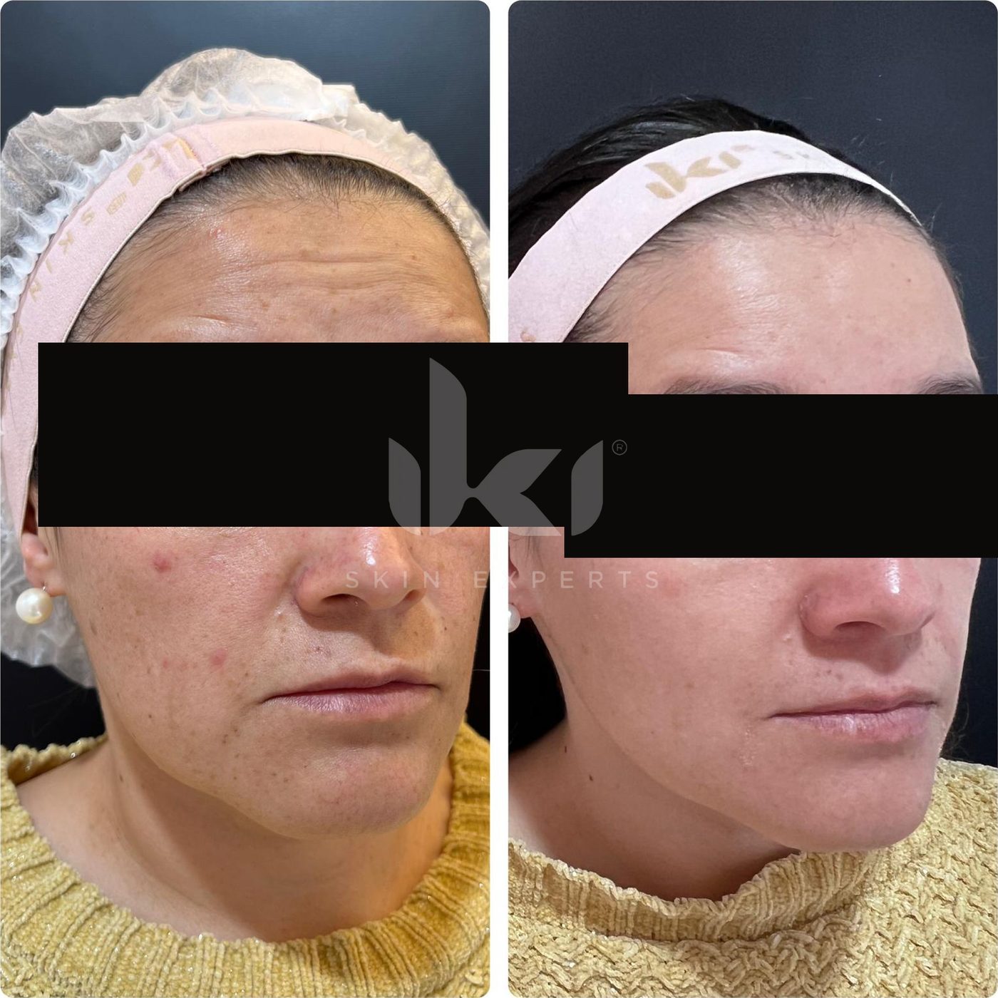 Antes y después de manchas y melasma en IKI Skin Experts, caso 10, identidad protegida