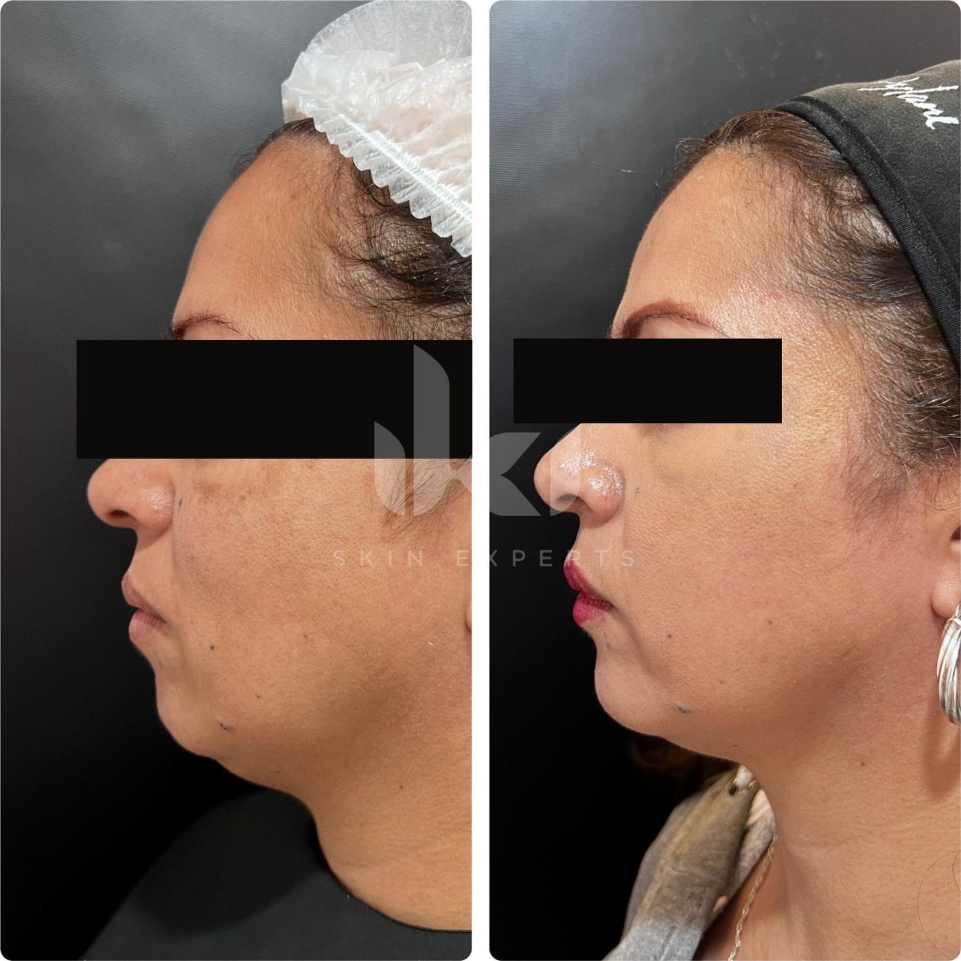 Antes y después de mentón · ácido hialurónico en IKI Skin Experts, caso 1, identidad protegida