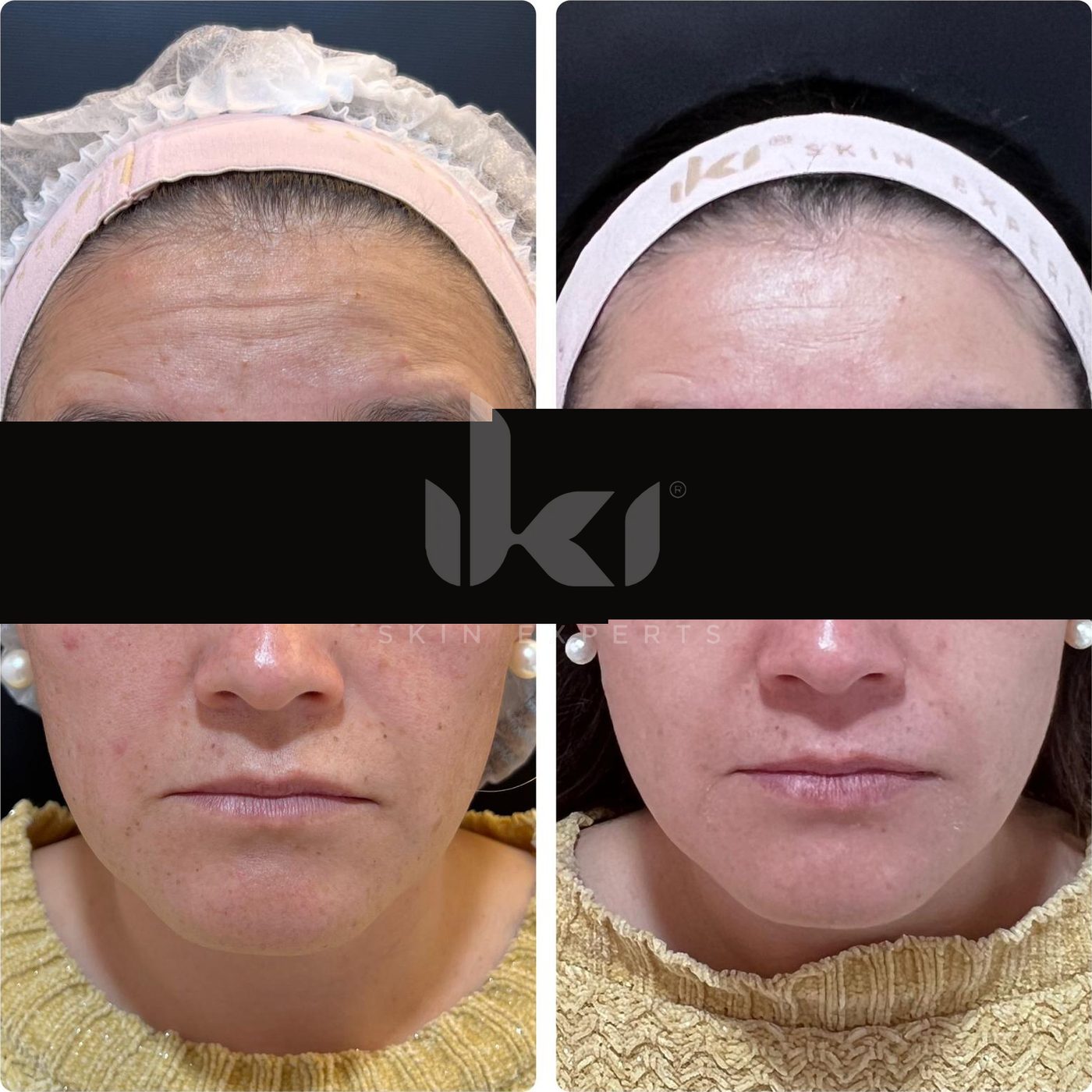 Antes y después de manchas y melasma en IKI Skin Experts, caso 11, identidad protegida