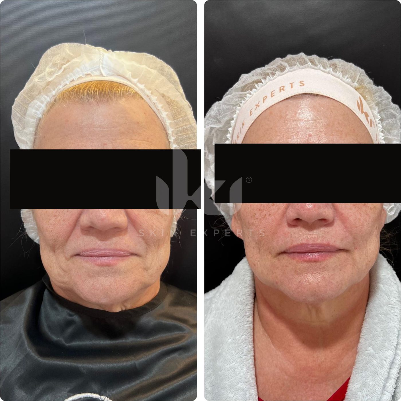 Antes y después de hifu · flacidez en IKI Skin Experts, caso 3, identidad protegida