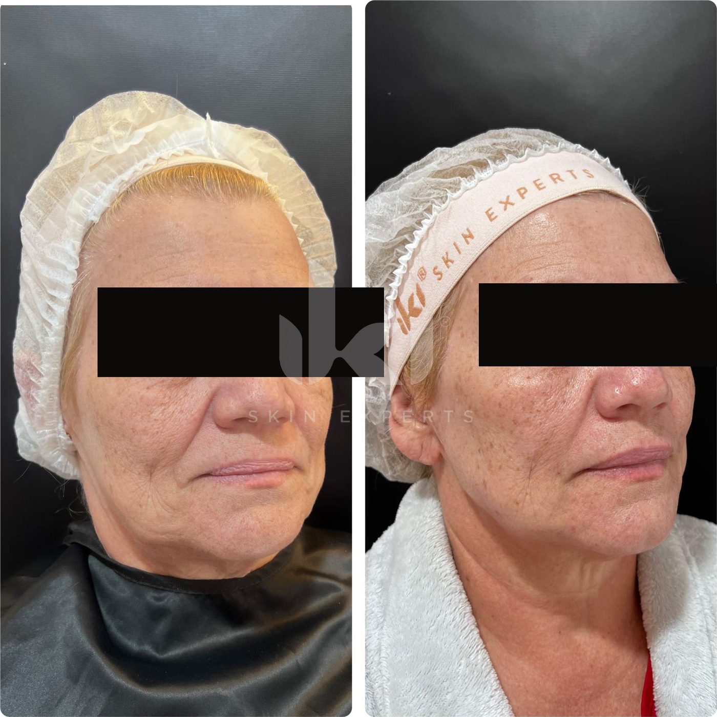 Antes y después de hifu · flacidez en IKI Skin Experts, caso 4, identidad protegida