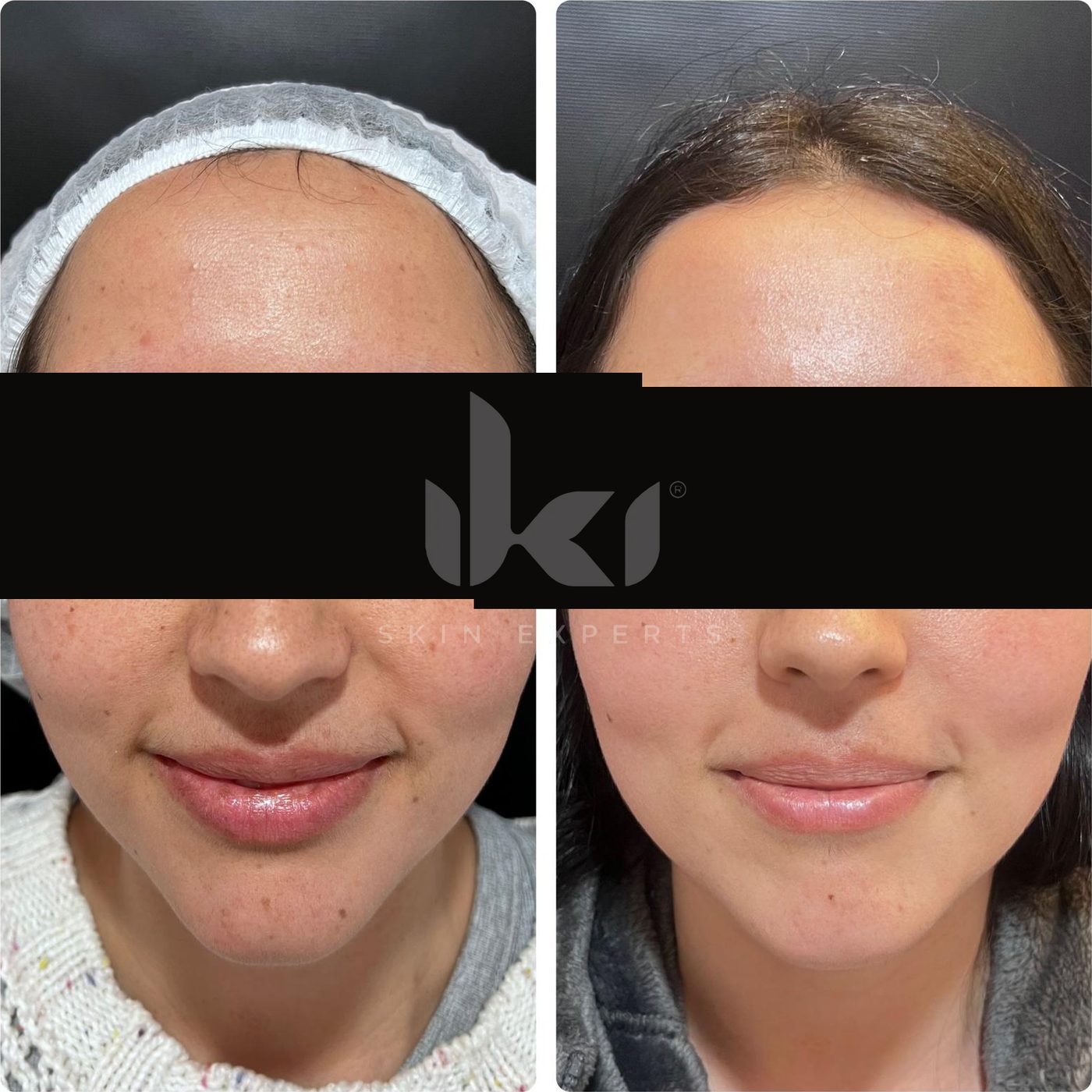 Antes y después de facial médico · hydrafacial en IKI Skin Experts, caso 2, identidad protegida