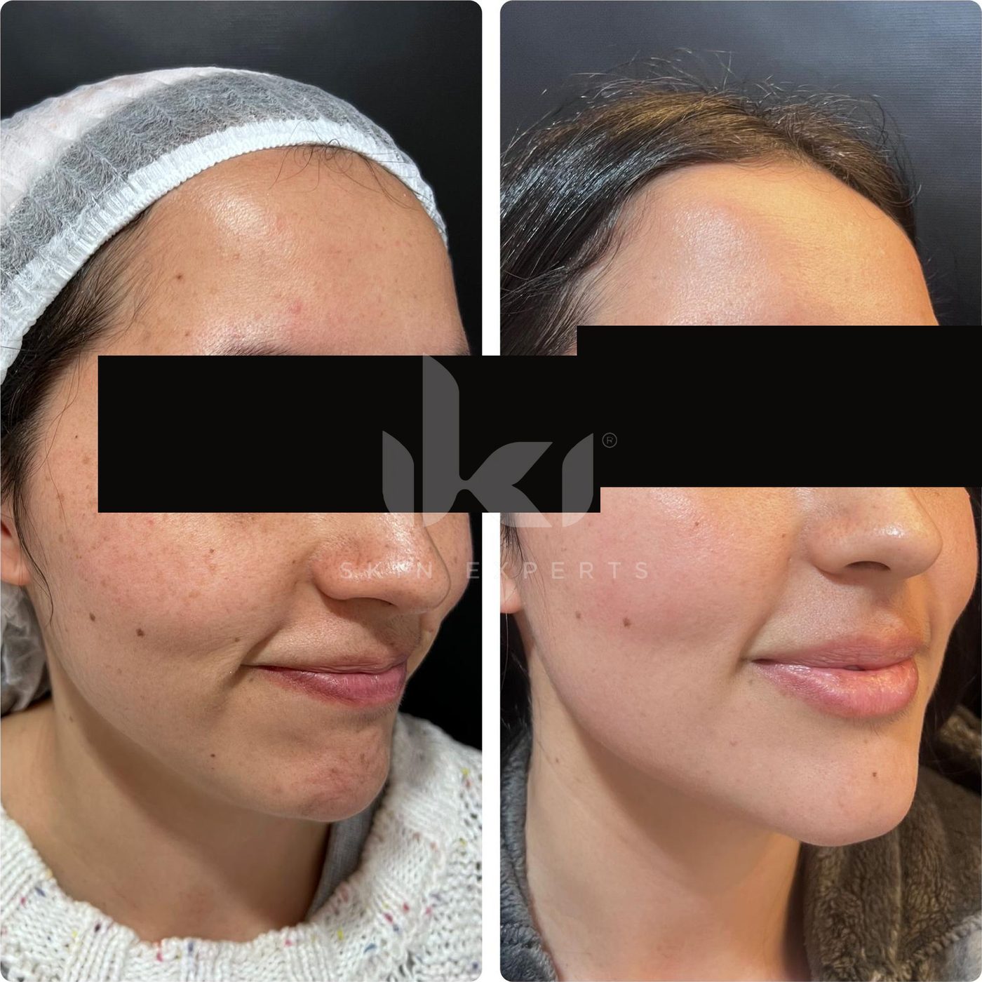 Antes y después de manchas y melasma en IKI Skin Experts, caso 12, identidad protegida