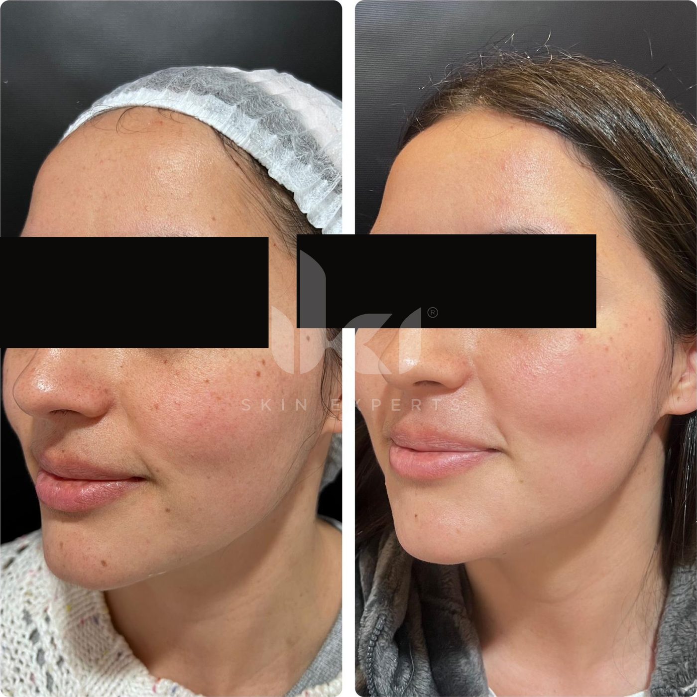 Antes y después de manchas y melasma en IKI Skin Experts, caso 13, identidad protegida