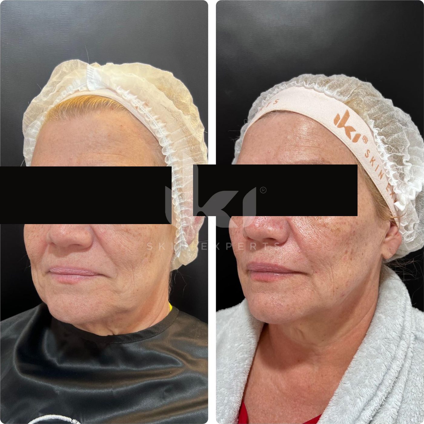 Antes y después de facial médico · hydrafacial en IKI Skin Experts, caso 3, identidad protegida