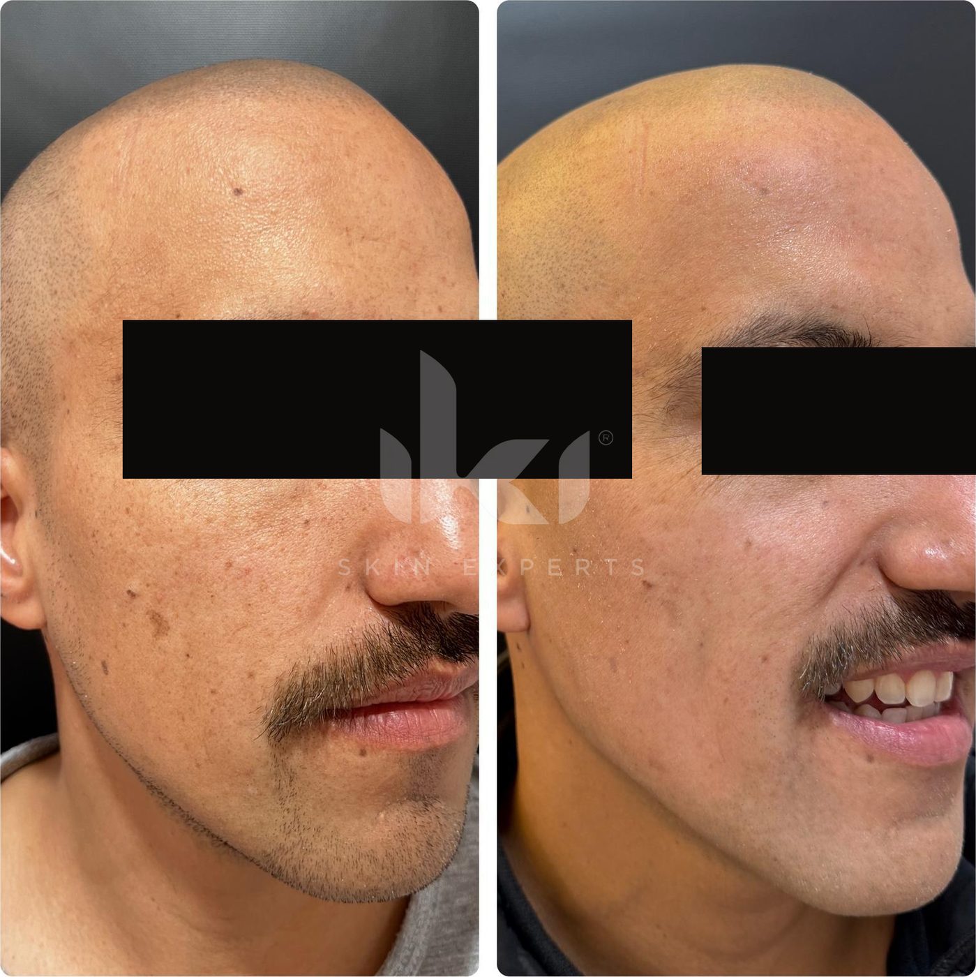 Antes y después de facial médico · hydrafacial en IKI Skin Experts, caso 4, identidad protegida