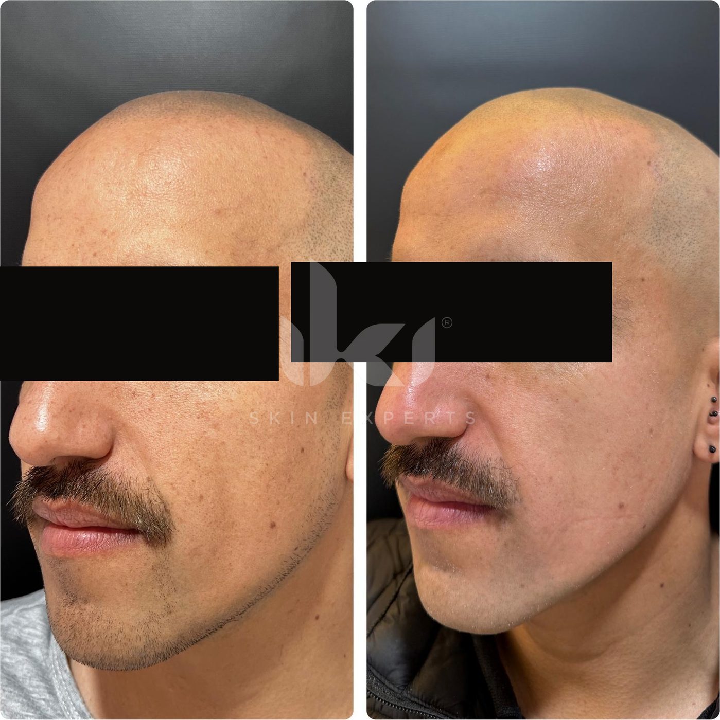 Antes y después de facial médico · hydrafacial en IKI Skin Experts, caso 5, identidad protegida