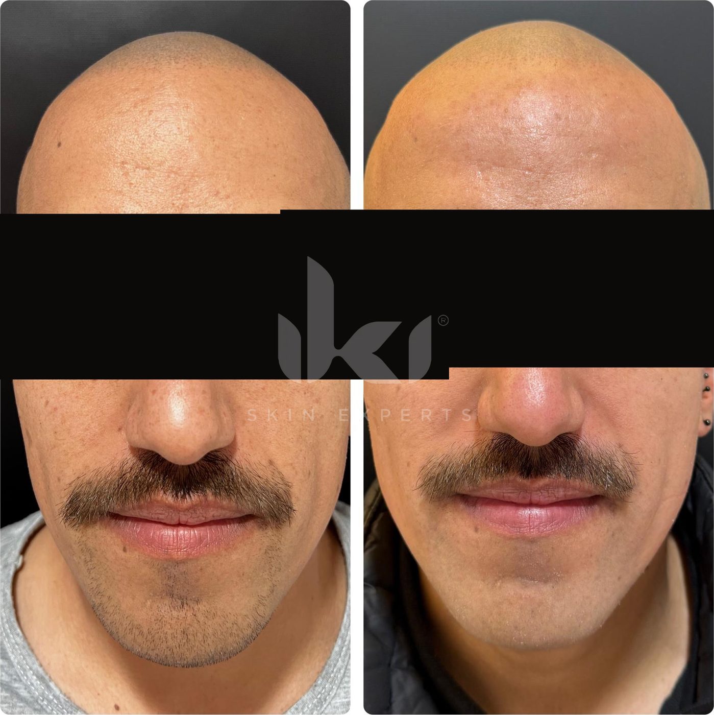 Antes y después de facial médico · hydrafacial en IKI Skin Experts, caso 6, identidad protegida