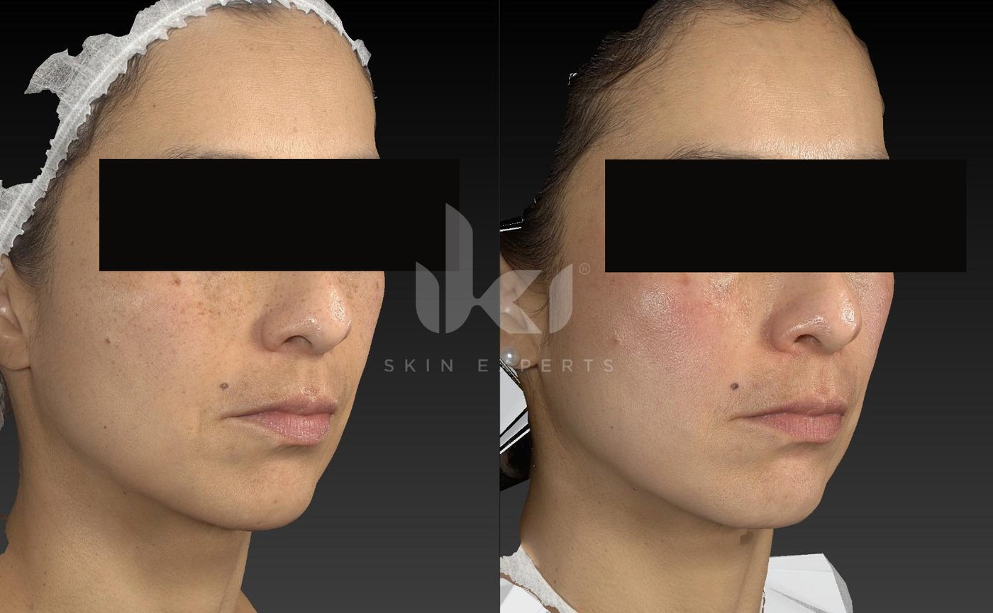 Antes y después de manchas y melasma en IKI Skin Experts, caso 14, identidad protegida