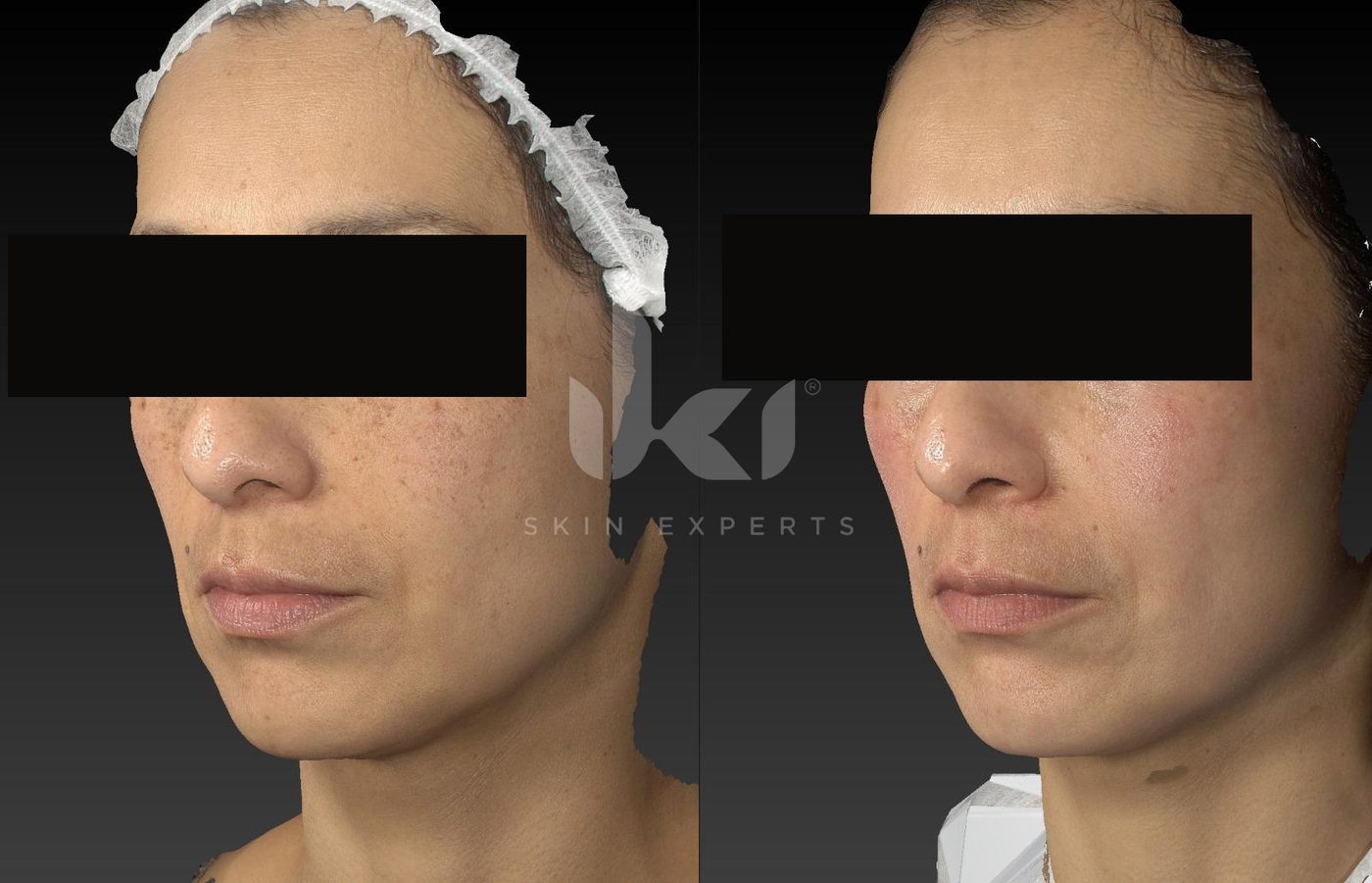 Antes y después de manchas y melasma en IKI Skin Experts, caso 15, identidad protegida