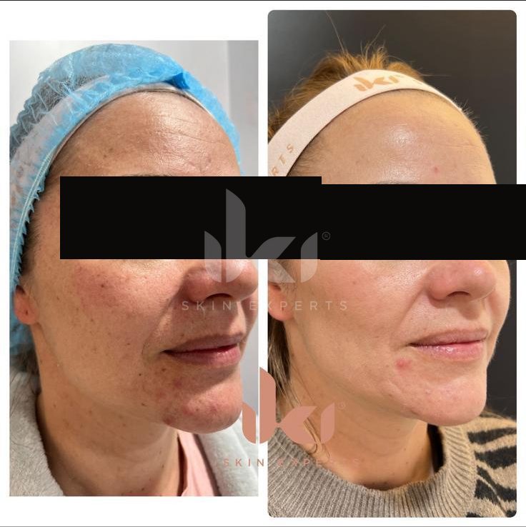Antes y después de rosácea en IKI Skin Experts, caso 3, identidad protegida