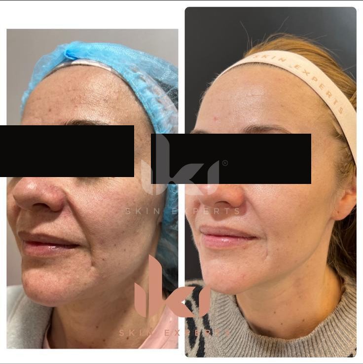 Antes y después de rosácea en IKI Skin Experts, caso 4, identidad protegida