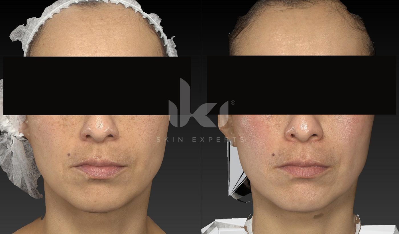 Antes y después de manchas y melasma en IKI Skin Experts, caso 16, identidad protegida