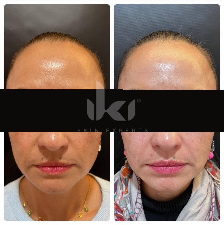 Antes y después de manchas y melasma en IKI Skin Experts, caso 17, identidad protegida