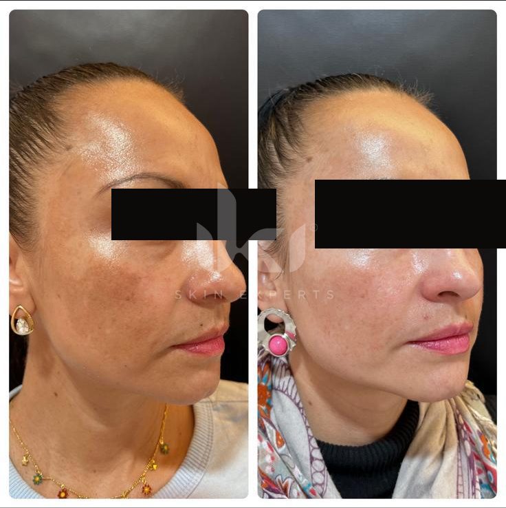 Antes y después de manchas y melasma en IKI Skin Experts, caso 18, identidad protegida