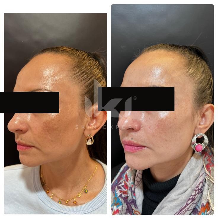 Antes y después de manchas y melasma en IKI Skin Experts, caso 19, identidad protegida