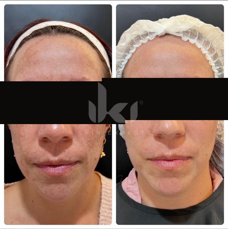 Antes y después de manchas y melasma en IKI Skin Experts, caso 20, identidad protegida