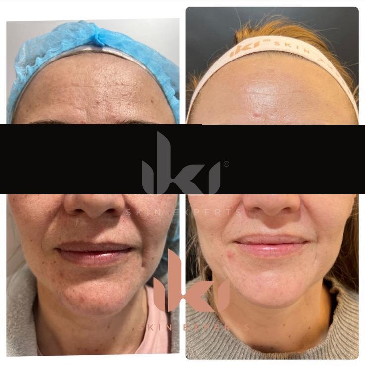 Antes y después de rosácea en IKI Skin Experts, caso 5, identidad protegida