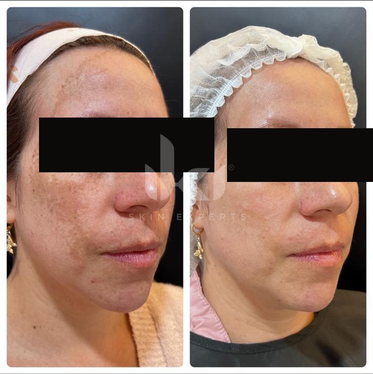 Antes y después de manchas y melasma en IKI Skin Experts, caso 21, identidad protegida