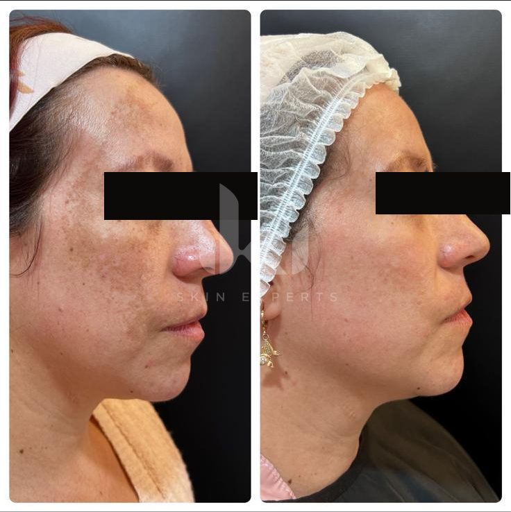 Antes y después de manchas y melasma en IKI Skin Experts, caso 22, identidad protegida