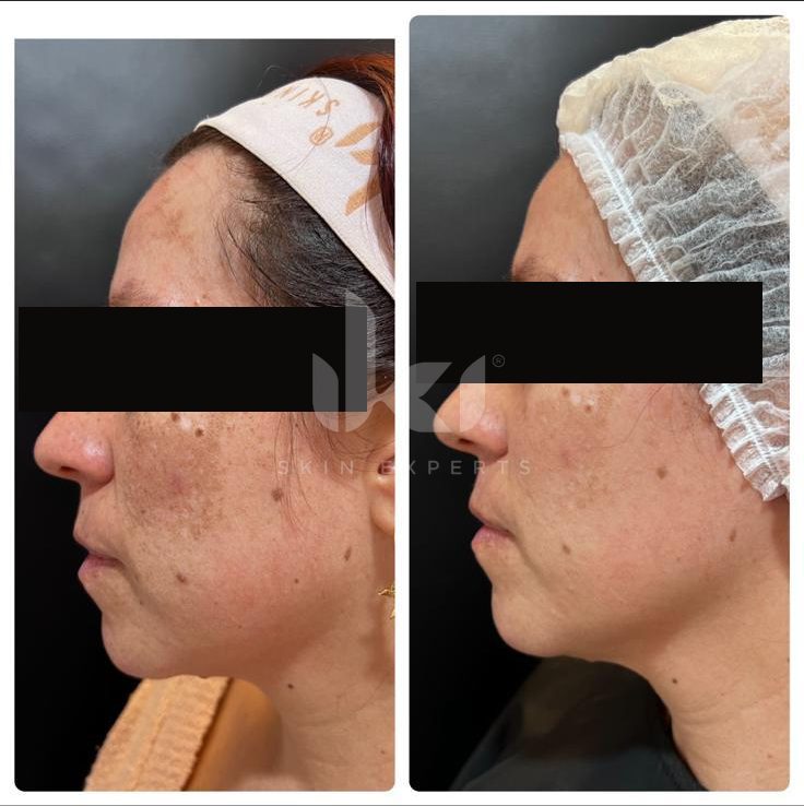 Antes y después de manchas y melasma en IKI Skin Experts, caso 23, identidad protegida